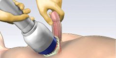 Penile Injection treatment for Erectile dysfunction